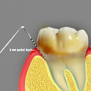 Dental Prophylaxis